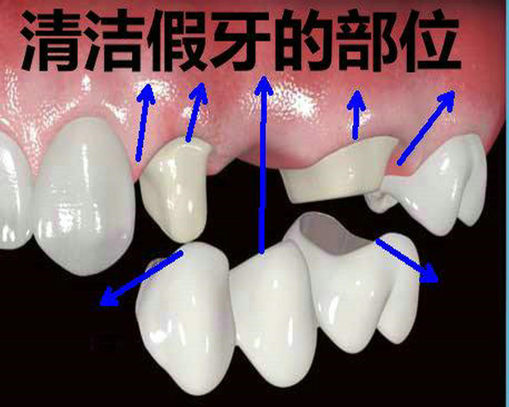 牙科医生讲义第十四讲：什么是  全  瓷  冠