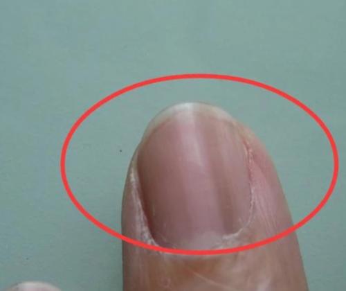 指甲上有条黑线是什么病？甲黑色素瘤or甲母痣？良性还是恶性？