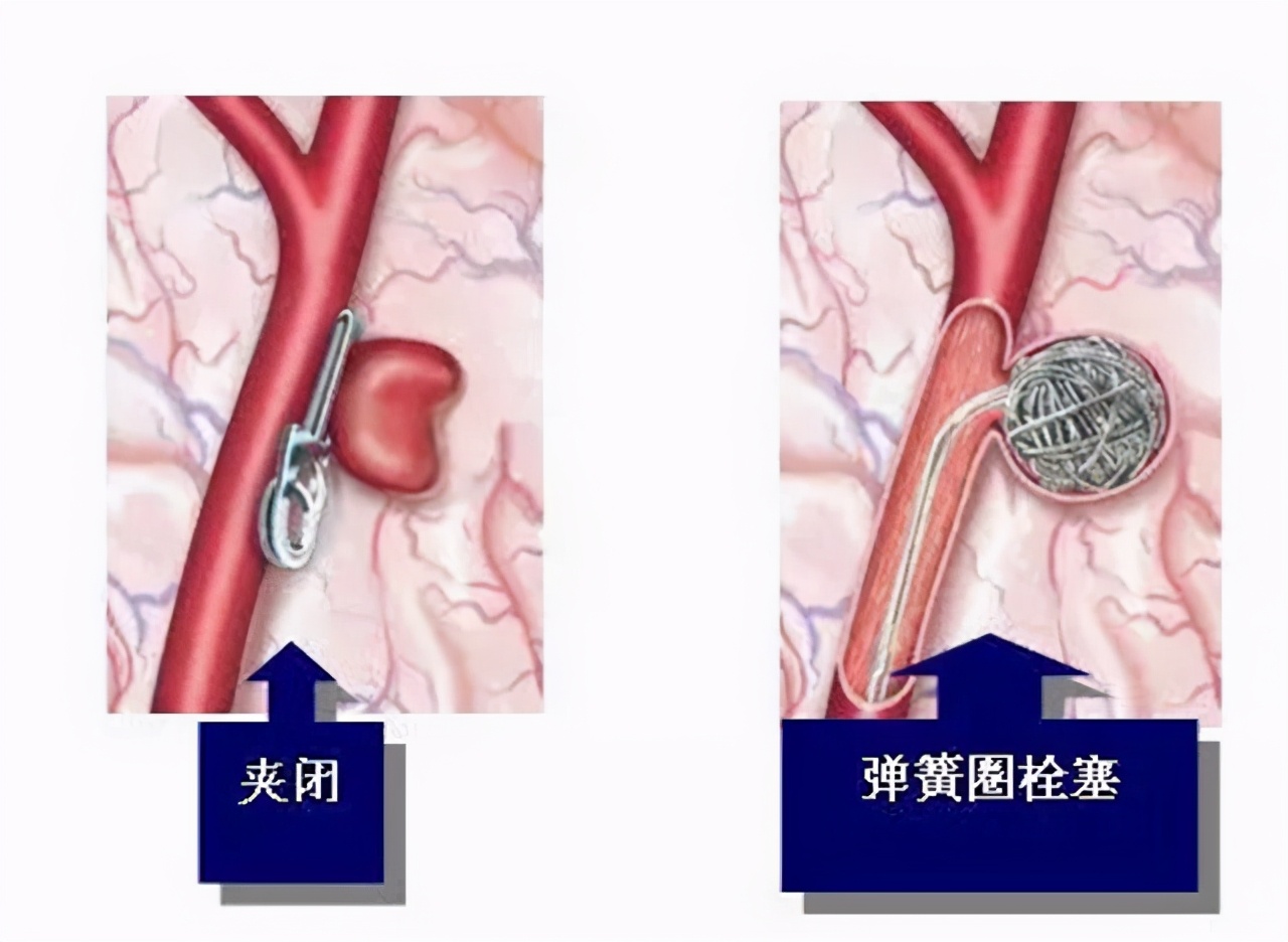 冠心病确诊，到底做冠脉CT，还是做冠脉造影？听听医生怎么说