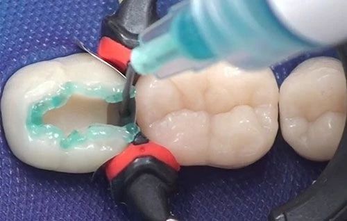 牙齿缝隙大怎么修复？牙缝过大影响美观和健康，需要及时治疗改善。