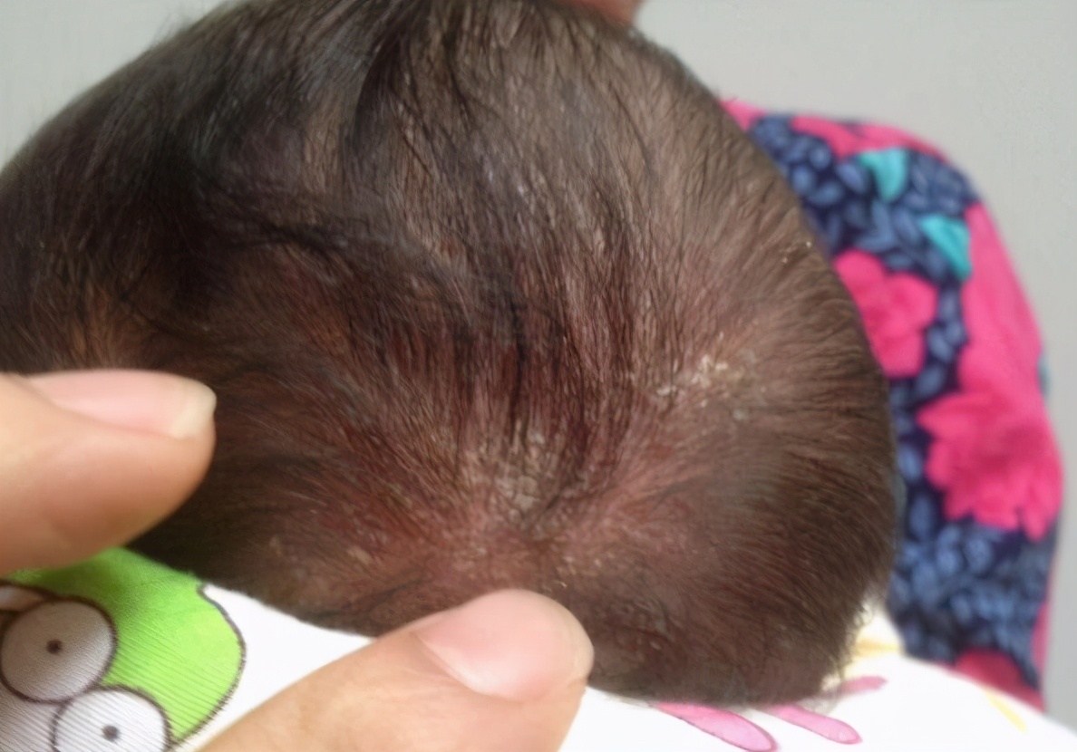 家长"手贱"抠宝宝乳痂,这个举动很坑娃,清理乳痂要分3个步骤