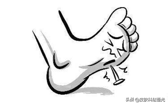 如何识别脚部鸡眼：症状特征与自我判断方法