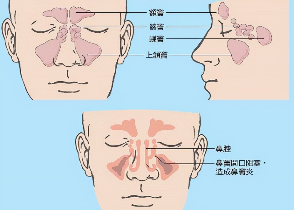 鼻窦炎的危害，鼻窦炎有哪些症状？
