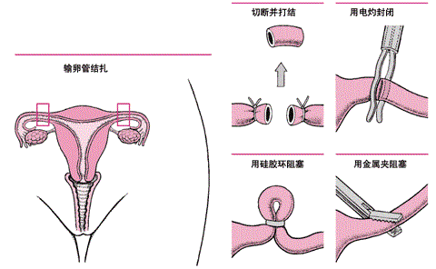 二胎剖宫产,医生问我要不要输卵管结扎?