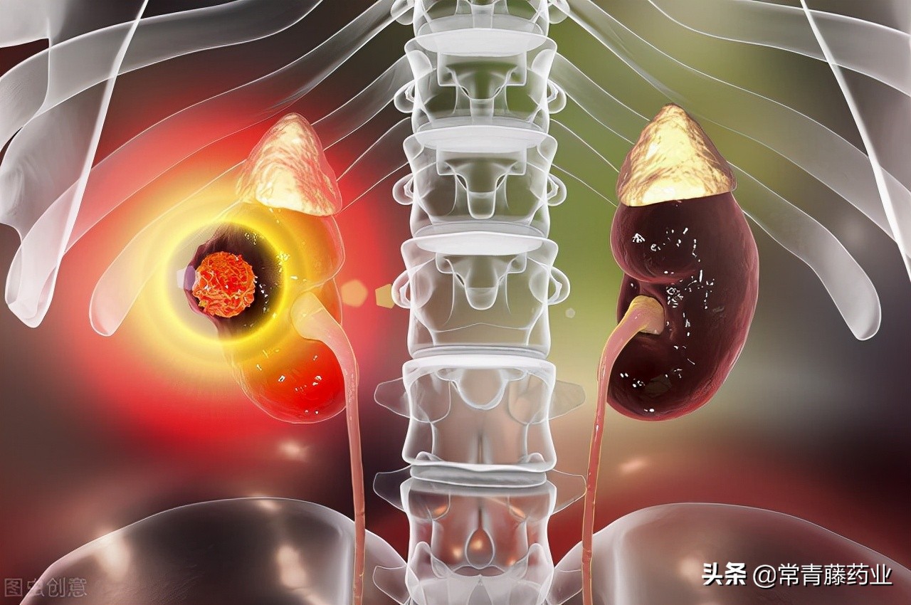 青岛市中心（肿瘤）医院“拆弹专家”腹腔镜下根治性切除巨大肾癌 - 青岛新闻网