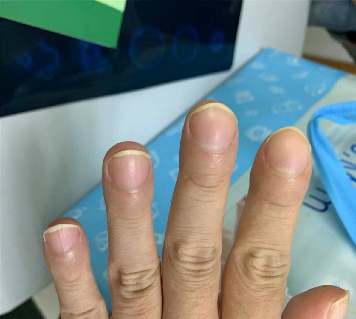 体内有病，手指先知？手指出现4种特征，要排除疾病或癌的可能