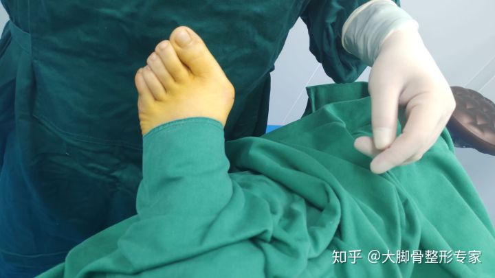 大脚骨朋友问：我这算什么程度的大脚骨啊？且看案例