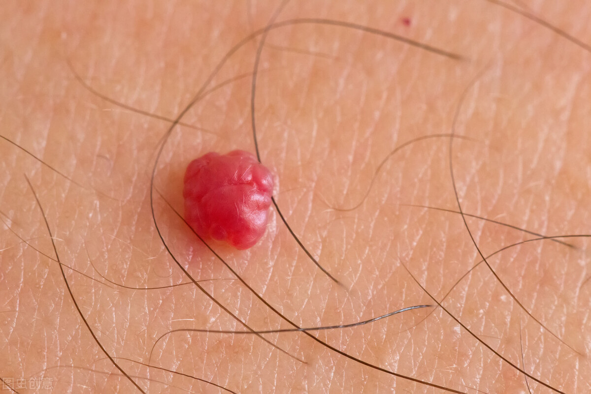 孩子身上长着血红色疙瘩是什么？可能是血管瘤，这6种类型你记住了吗？