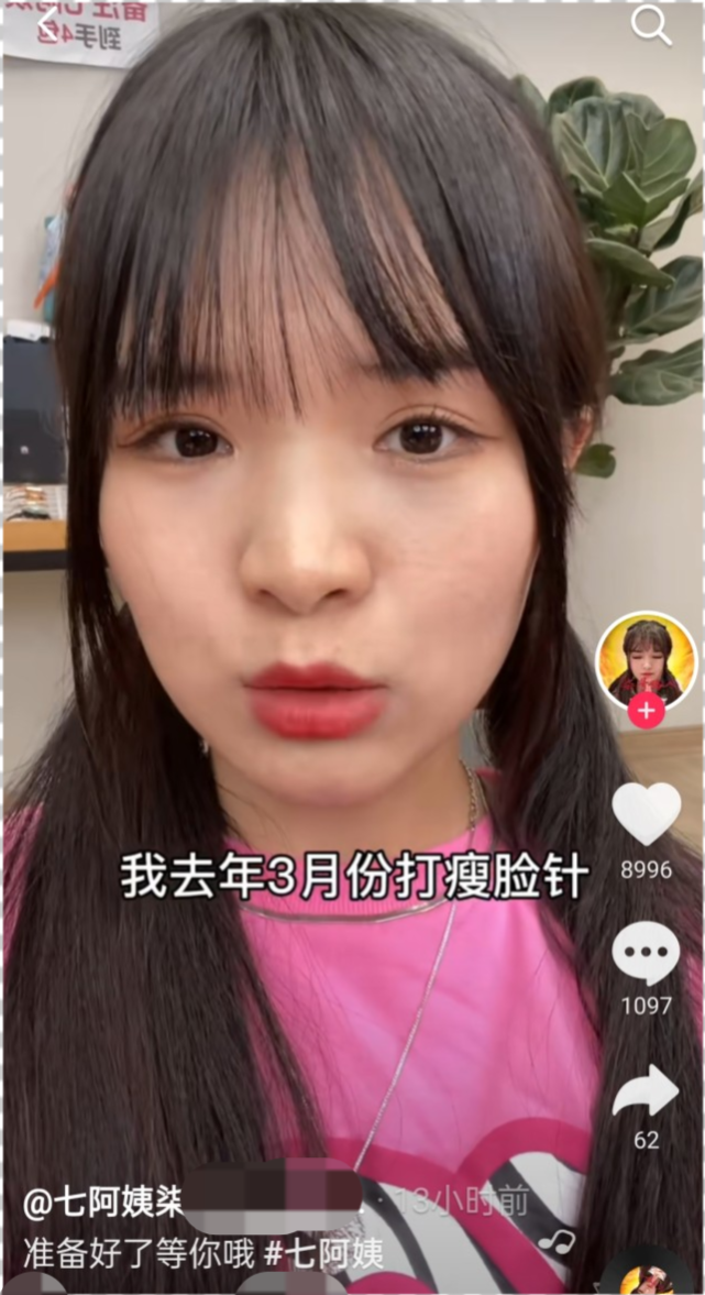 47岁七阿姨承认打瘦脸针！称打瘦脸针会落下后遗症：法令纹加重