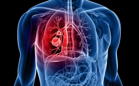 辟谣：肺占位就是肺癌？大部分不是，但有这些症状要小心