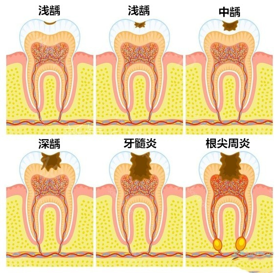 蛀牙要怎么治疗？