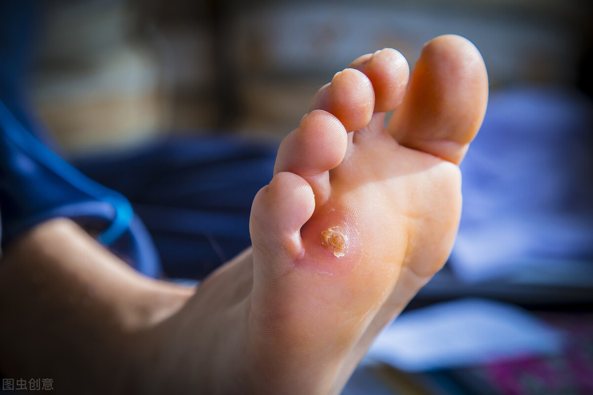 脚底长了"鸡眼"怎么办?挖掉还会长吗?教你4招方法有效应对