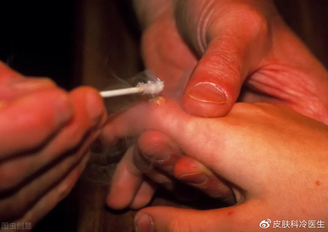 便宜实用且方便:液氮冷冻,了解一下?