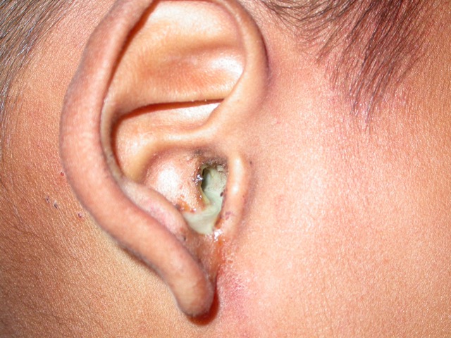耳朵发炎的症状图片图片