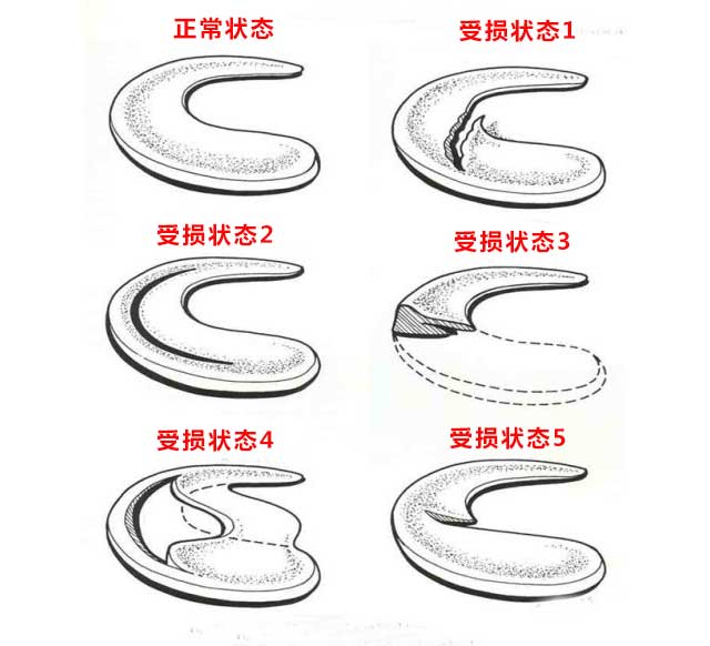 半月板损伤要缝合还是切除？哪种手术方式好？听听医生怎么说