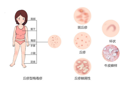 上覆糠秕样鳞屑的玫瑰色的斑丘疹，先有母斑，可能是玫瑰糠疹