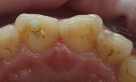 为什么有些牙齿缺损后需要打桩才能修复？不同的桩冠区别在哪？