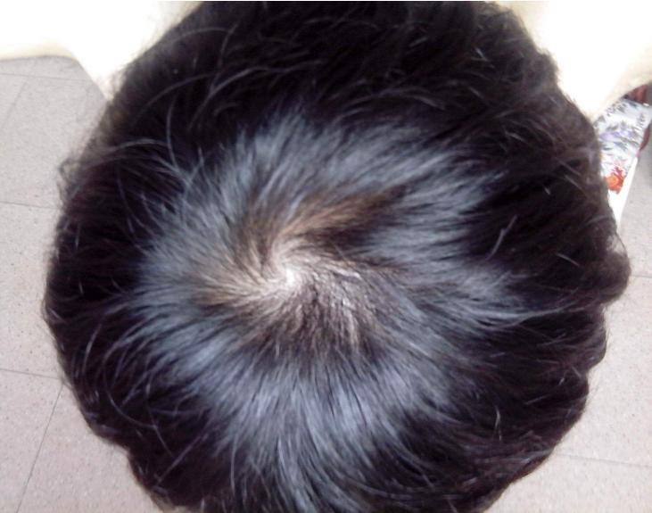 不少地方民间都有"一旋愣,二旋横,三旋坏得要人命"的说法,意思是一个