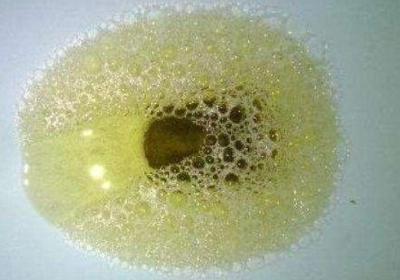 医生提醒:尿液出现这3种颜色,要注意啦!身体可能在在向你求救