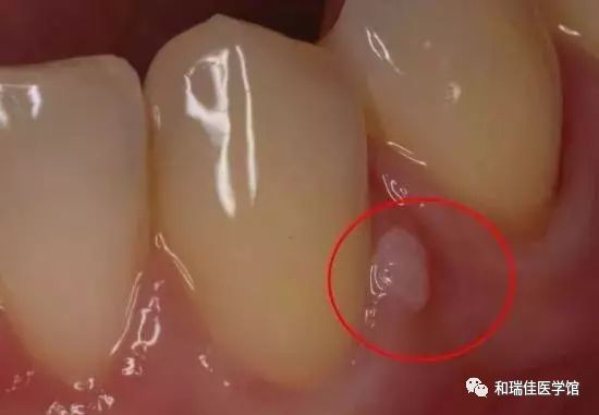 牙龈上长脓包，挤掉后还反复长出，怎么回事？