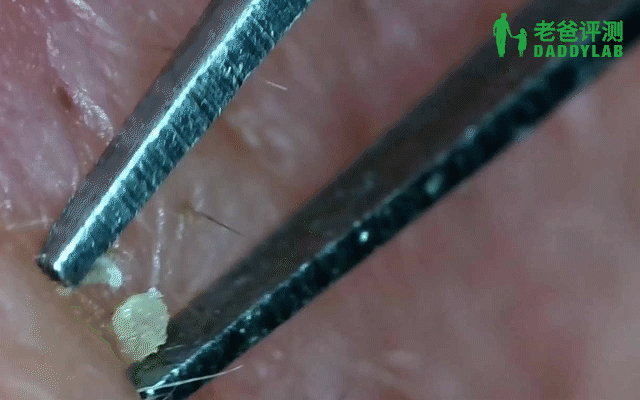 黑头究竟要怎么去？我们拔出并放大了四种类型的黑头