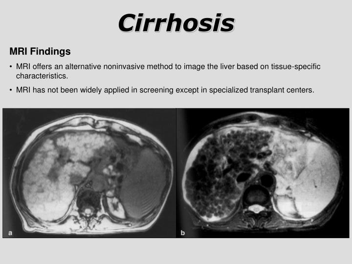 肝弹准确吗？肝病专家详解B超、CT、磁共振等肝硬化的无创检查！