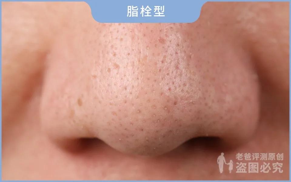 黑头究竟要怎么去？我们拔出并放大了四种类型的黑头