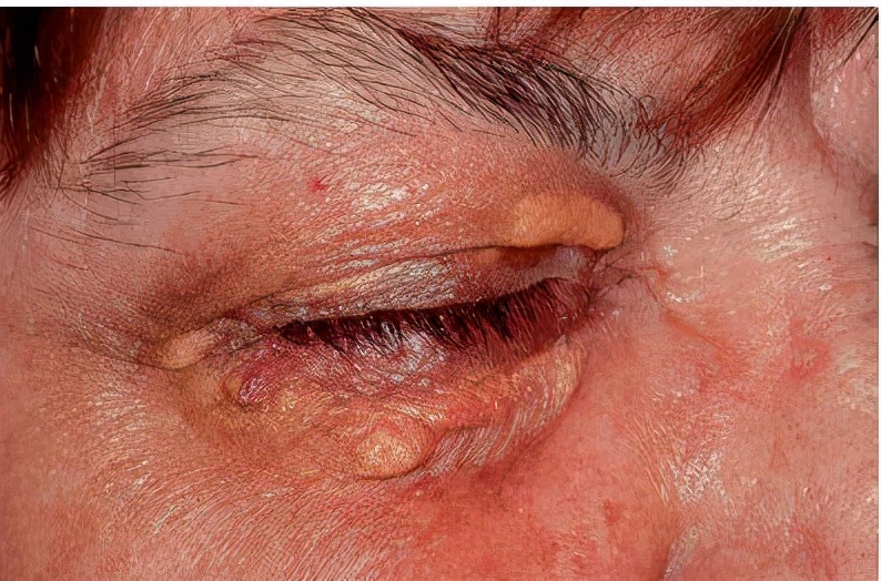 脸上长小颗粒是怎么回事?能去除吗?一文给你说清楚