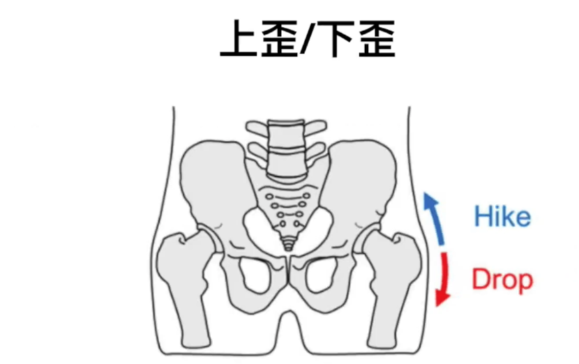 因为骨盆歪掉，所以常常腰酸背痛？如何改善，矫正有用吗？