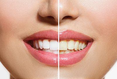 明星爆款！牙膏界的“爱马仕”，快速让你的牙齿变白，改善口臭
