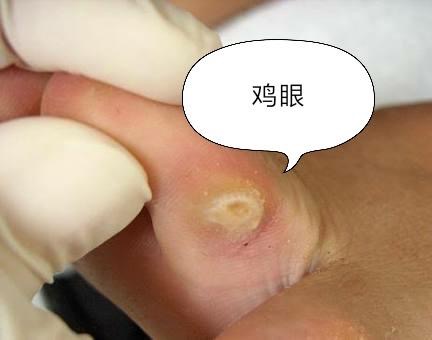脚上长的是鸡眼、瘊子，还是老茧，你搞清楚了吗？