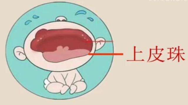 新生儿出生就有两颗牙,医生:是"诞生牙",相似的还有"马牙"