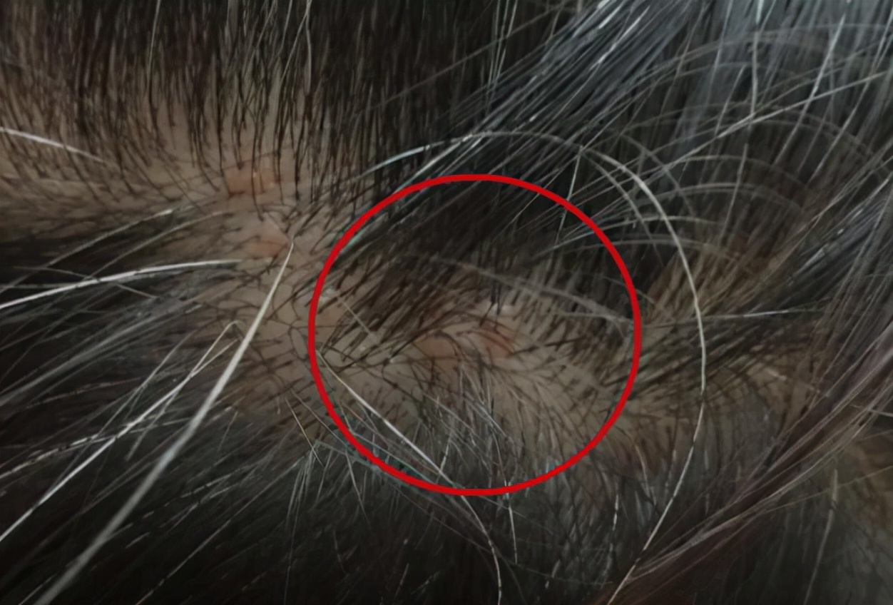 皮肤毛囊堵塞图片(为什么头皮总长) - 赤虎壹号