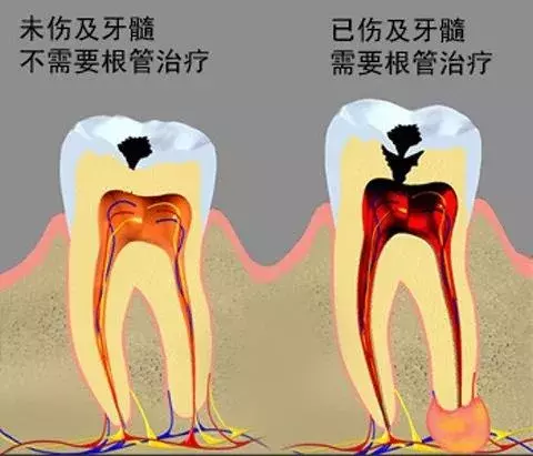 几十块钱就能补好的牙,久拖不治,以至要花上万,冤不冤?