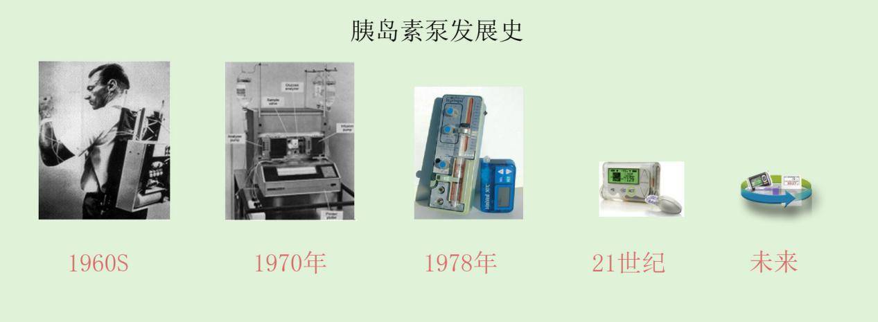 解放糖尿病患者的胰岛素泵，佩戴后可以放开吃喝吗？医生告诉你