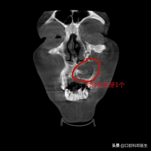 埋伏阻生牙不拔除，长期埋伏隐患多！