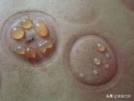 健康科普堂 | 拔罐讲义