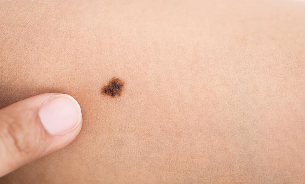 去脸上的痣多少钱一颗身上长的