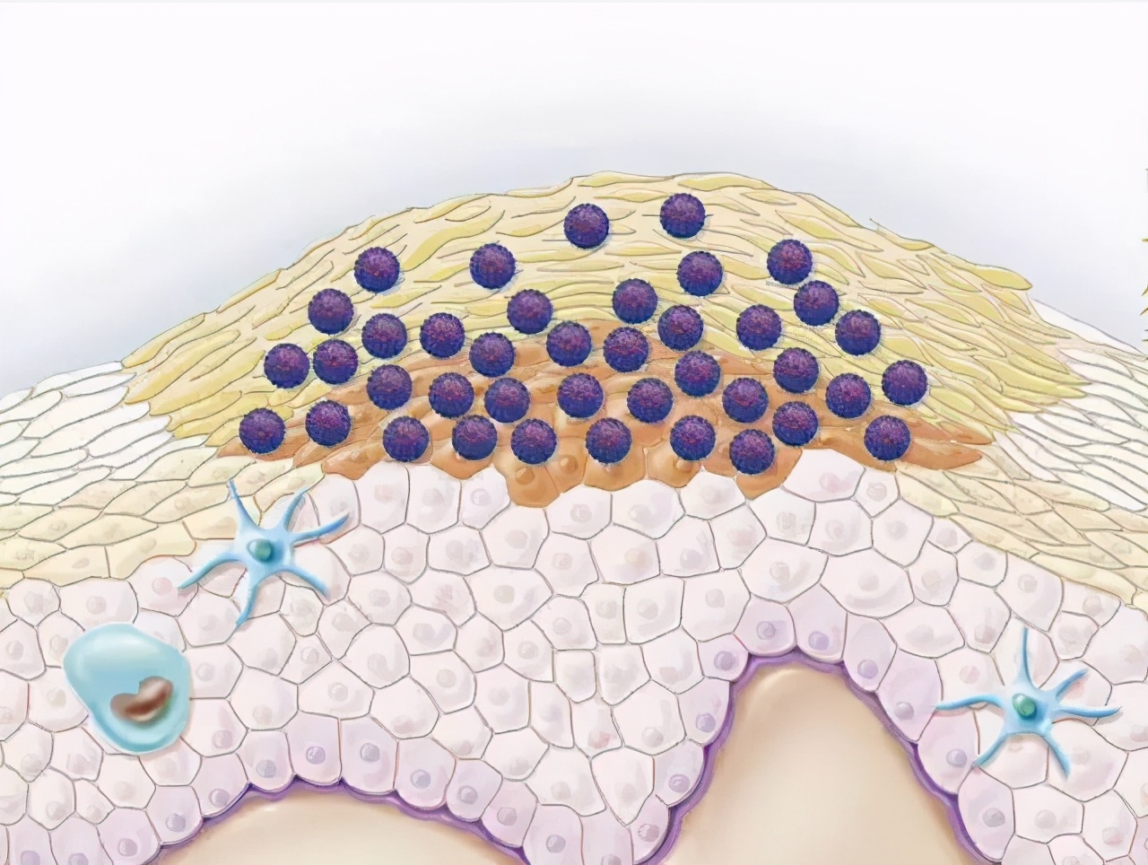 肛门长了个"小肉球",是痔疮还是尖锐湿疣?教你怎么区分
