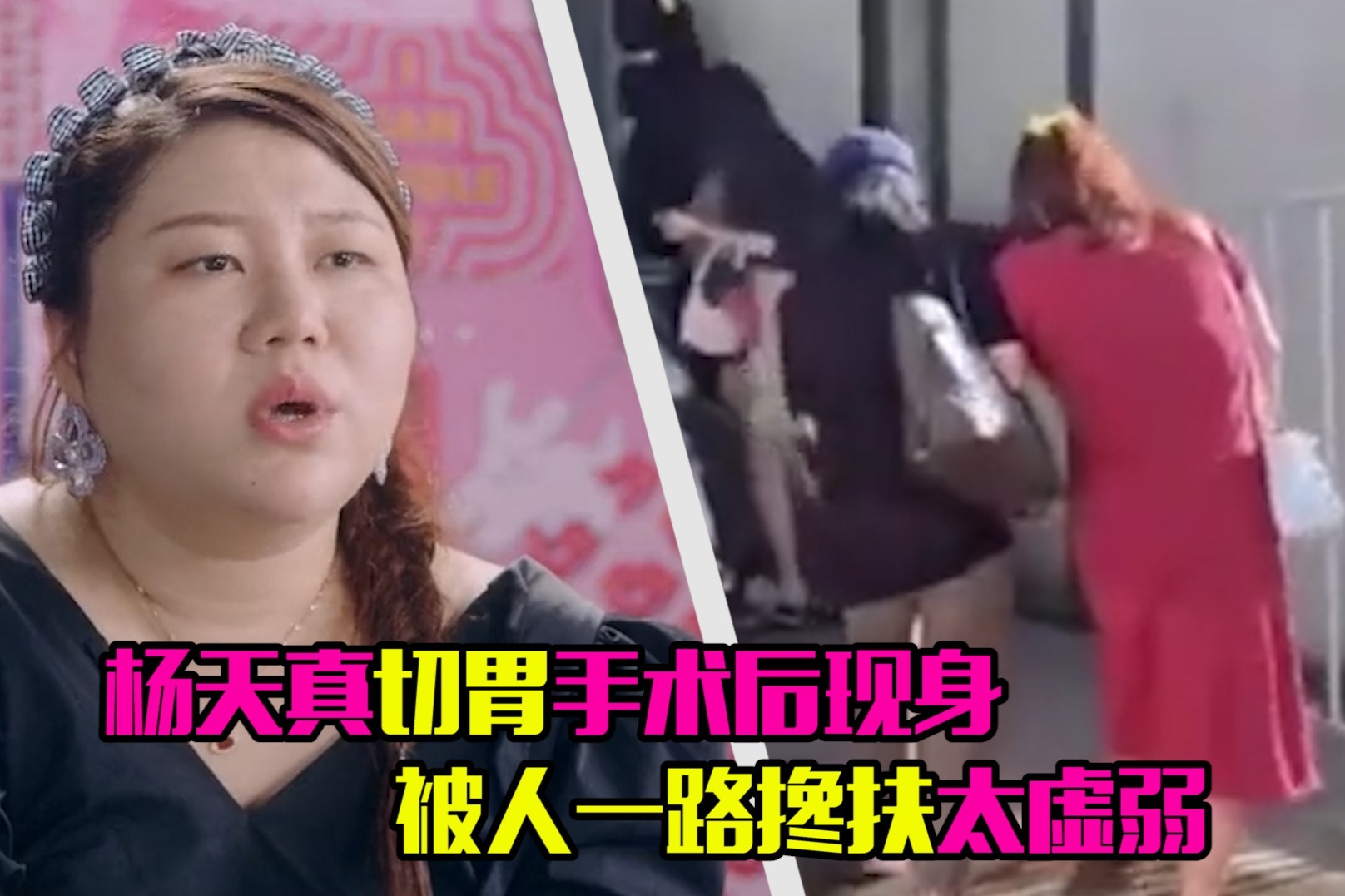 切掉大半个胃，只为了治疗糖尿病？减重手术治疗糖尿病可靠吗？