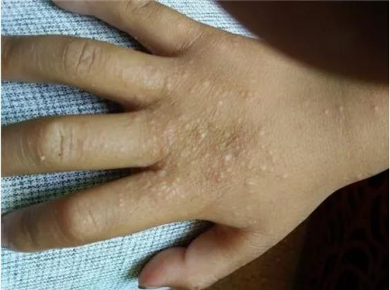 一,沙土性皮炎,是玩沙土引起的吗?