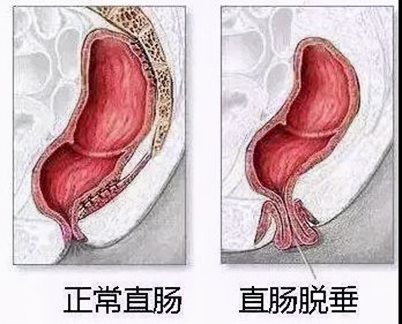 婴儿脱肛初期图片（直肠脱垂）