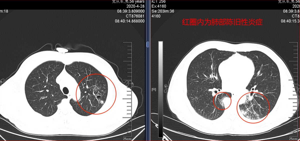 中医药联合化疗治疗肺腺癌取得奇效：肿瘤居然消失了