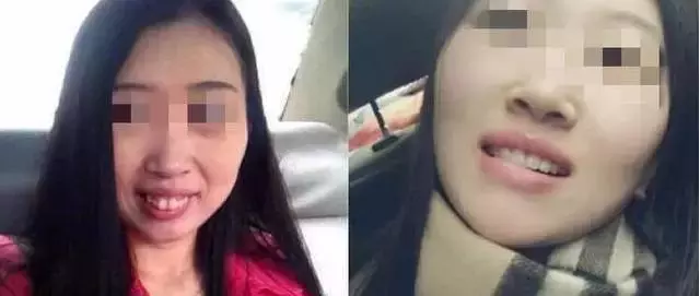 龅牙嘴突+露龈笑:牙齿矫正告诉你这些都还有救