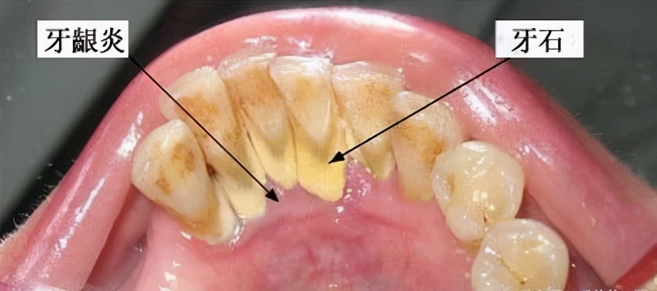 用手抠掉牙结石？医生劝你住手，用绝佳方法清除难道不香吗？