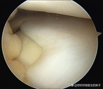 走走路突然膝盖就软了，要摔倒，还疼，是啥情况？医生详细告诉您