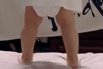 婴儿屁屁破皮护理指南：宝宝臀部皮肤破损的处理方法与预防措施