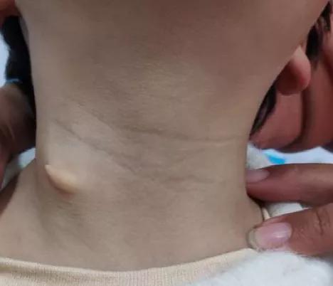 宝宝脖子有"小孔",当心是鳃瘘!