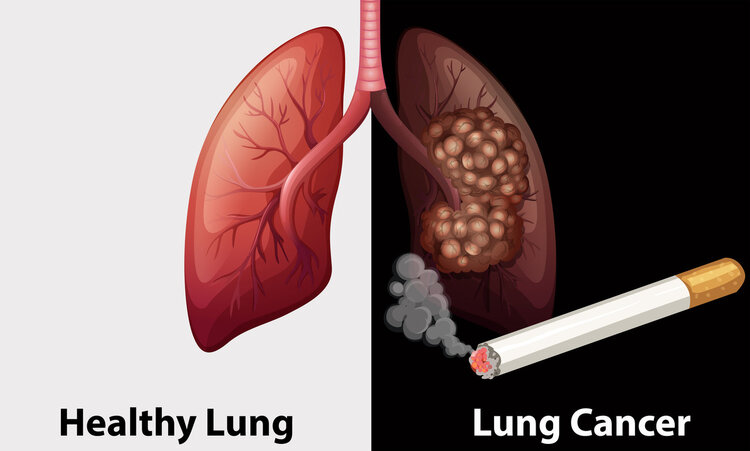 吸烟导致肺癌