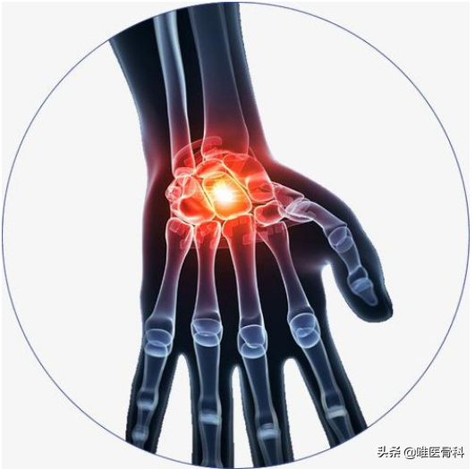 你可能得了"手骨性关节炎"